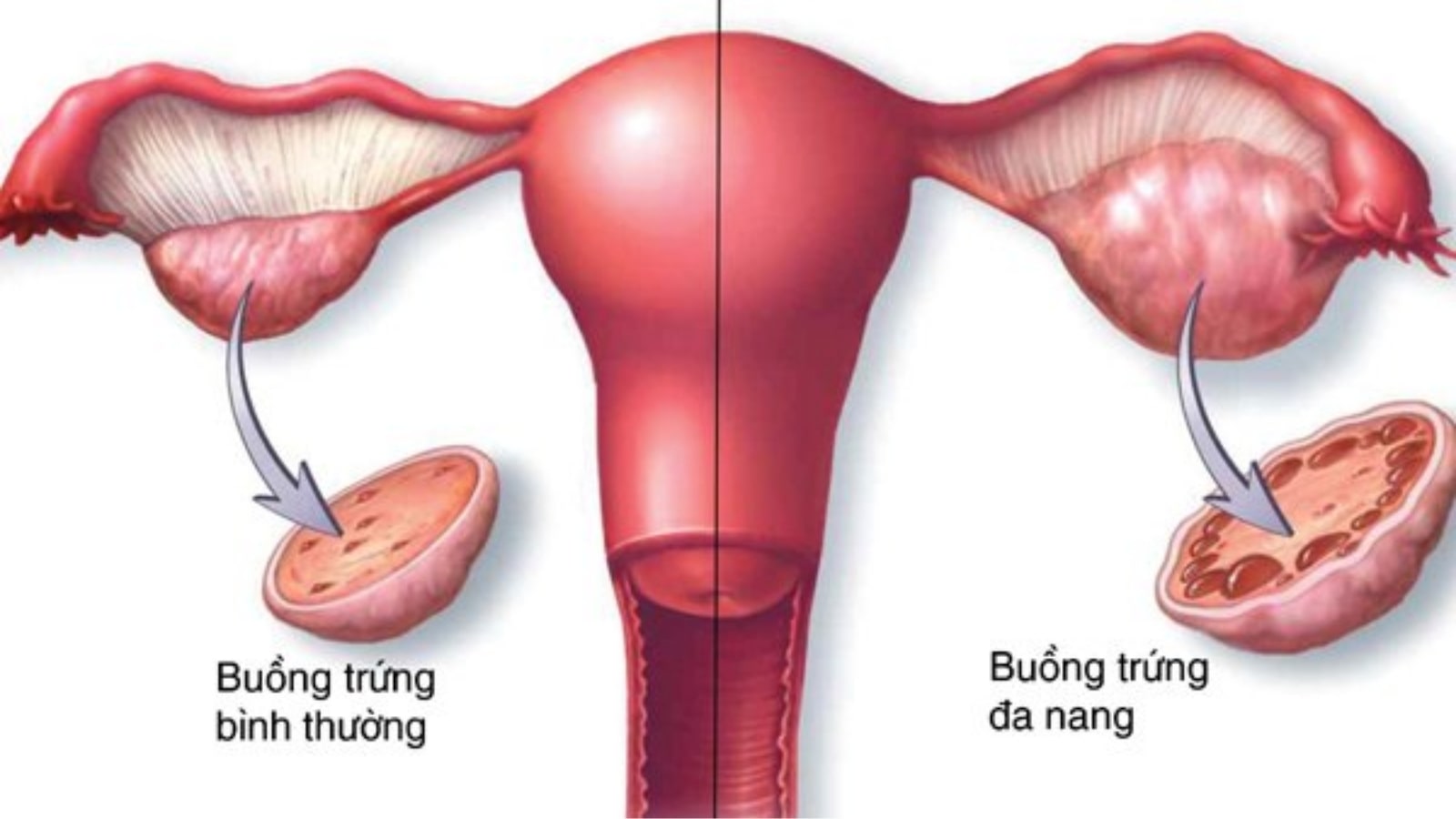 chữa buồng trứng đa nang bằng thuốc nam​
