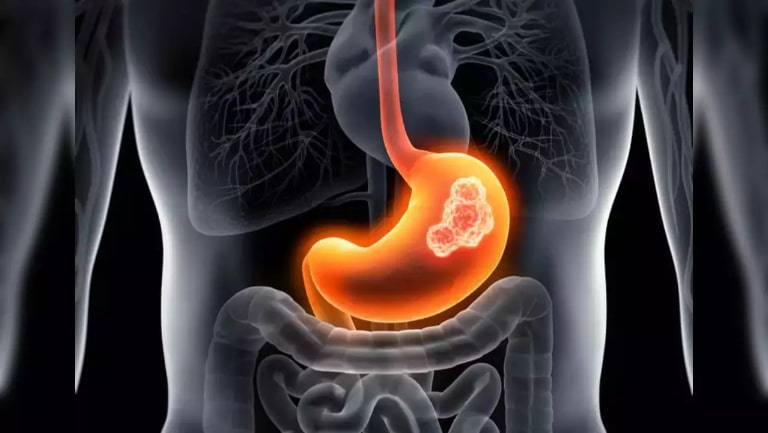 khối u trong dạ dày có nguy hiểm không​