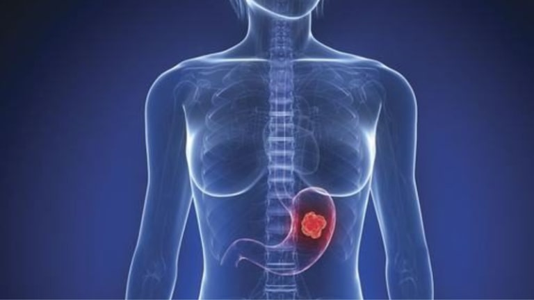 khối u trong dạ dày có nguy hiểm không​