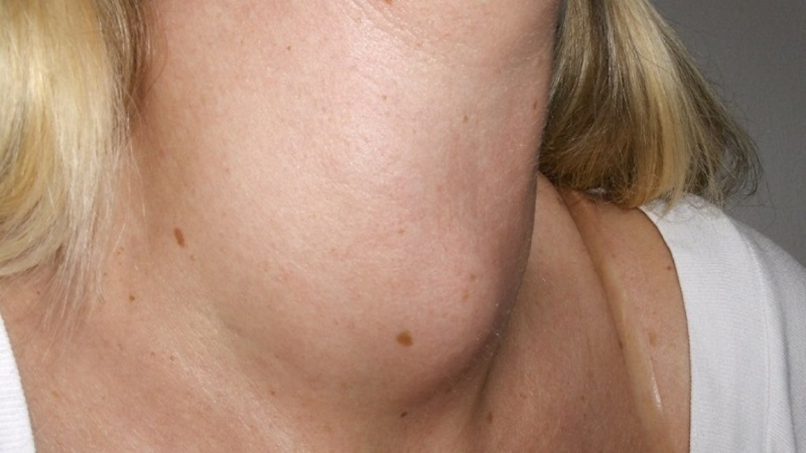 những cây thuốc nam chữa bệnh bướu cổ