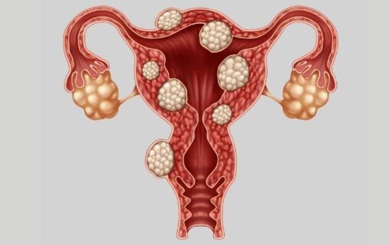 Tắc vòi trứng, lạc nội mạc tử cung và dị dạng tử cung